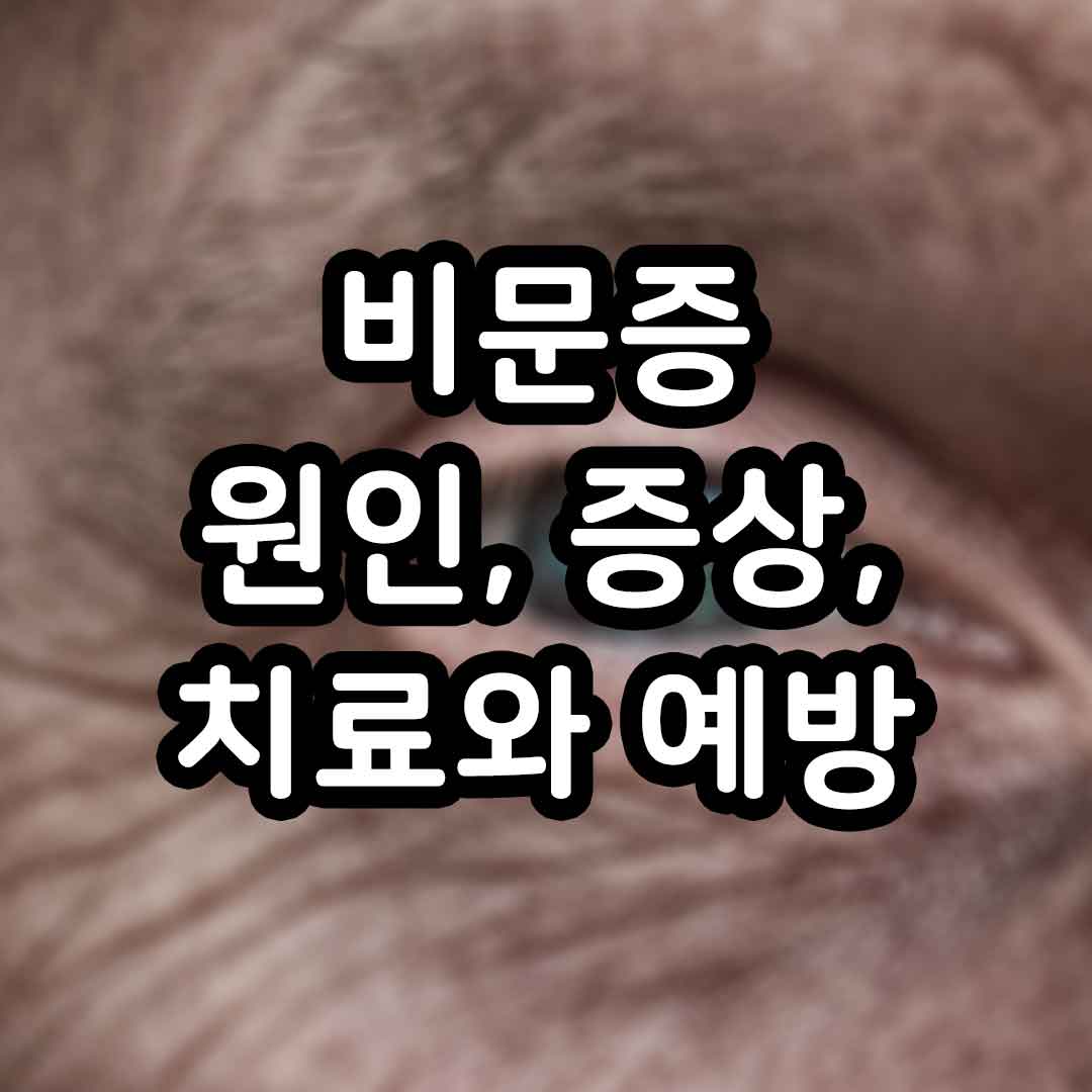 비문증의 원인, 증상, 치료와 예방