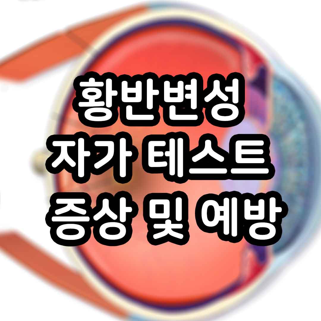 황반변성, 자가 테스트를 통한 증상 및 예방치료법