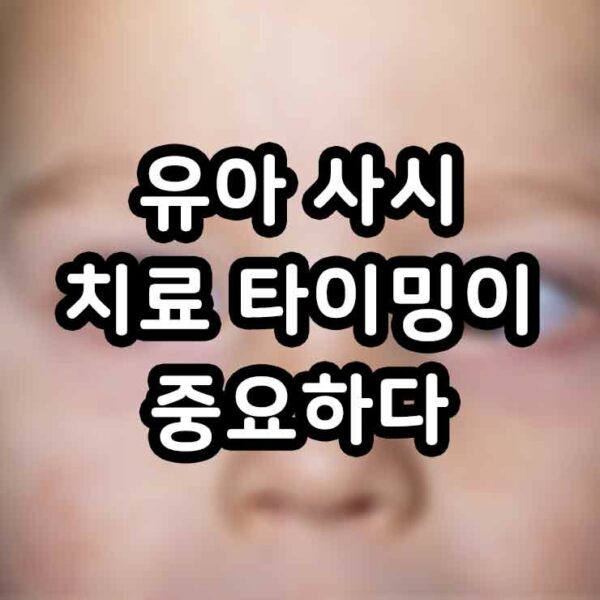 유아 사시 치료 타이밍이 중요하다 신생아 사시 소아 사시 썸네일