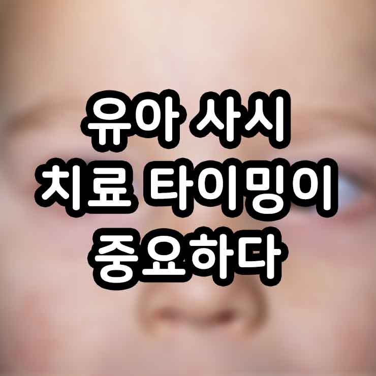 유아 사시 치료 타이밍이 중요하다 신생아 사시 소아 사시 썸네일